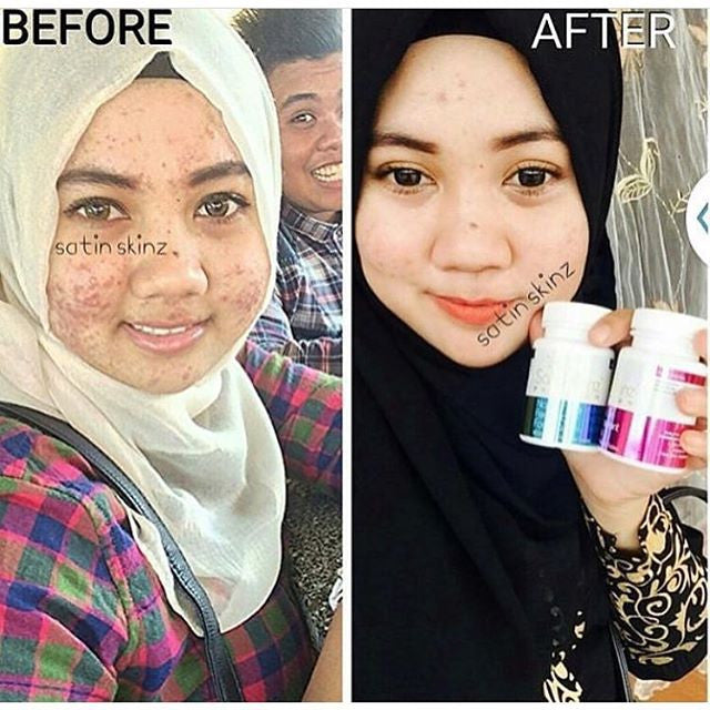 SatinSkinzGluta turn severely active acne to smoother and fairer skin!