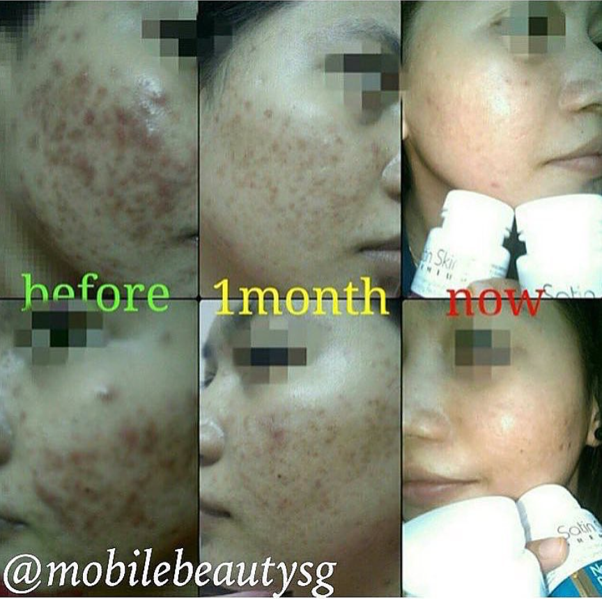One of the more challenging skin condition!